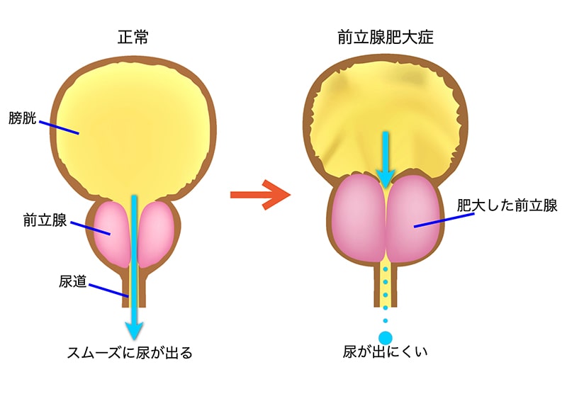 前立腺肥大症の説明図。左側が正常な状態で膀胱、前立腺、尿道が描かれ、スムーズに尿が出ることを示している。右側が前立腺肥大症の状態で、肥大した前立腺が尿道を圧迫し、尿が出にくい状態を示している。